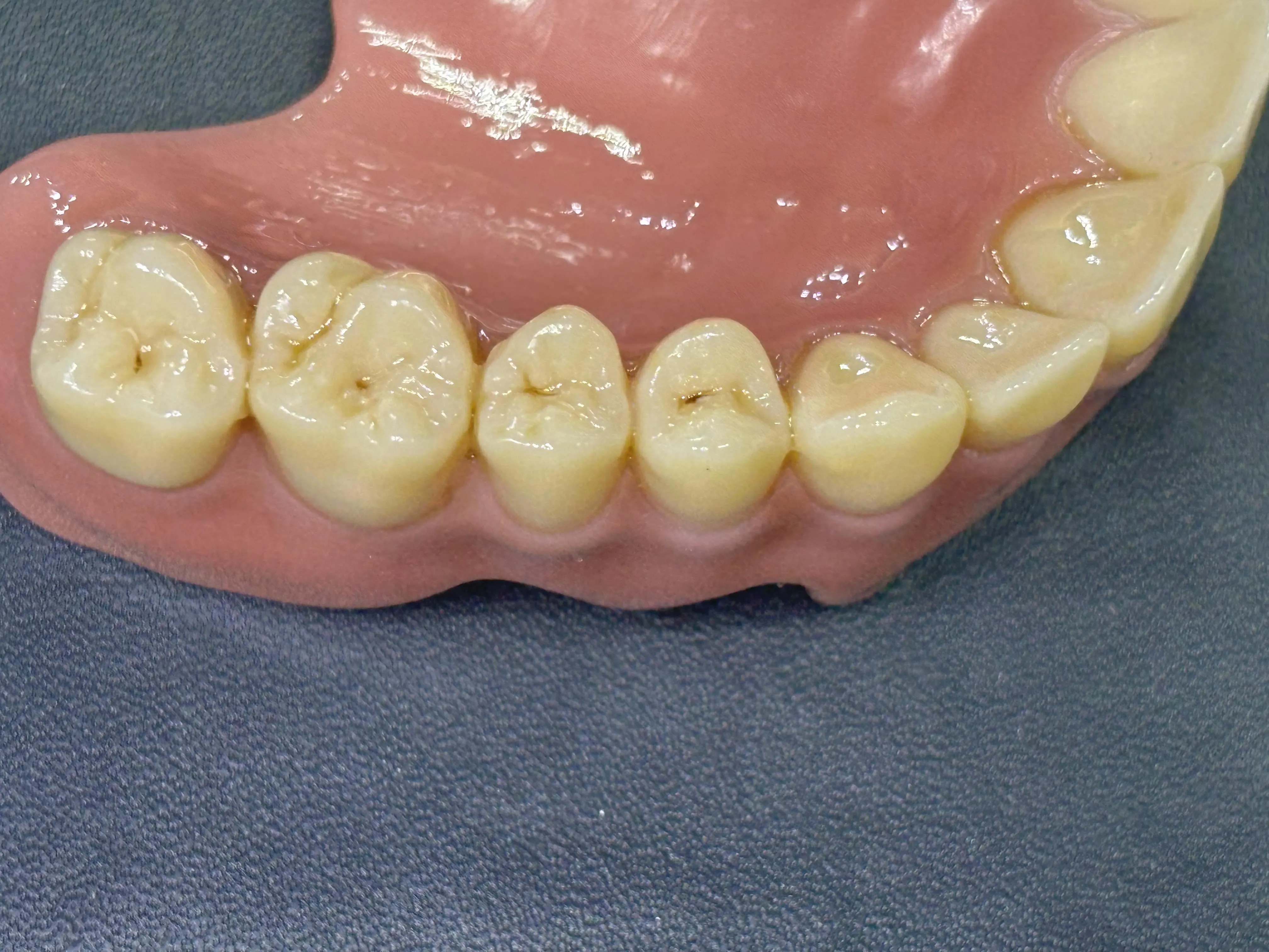 removable-denture